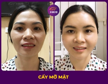 CẤY MỠ
